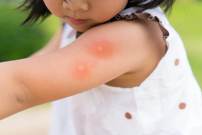 Mückenstiche am Arm des Babys