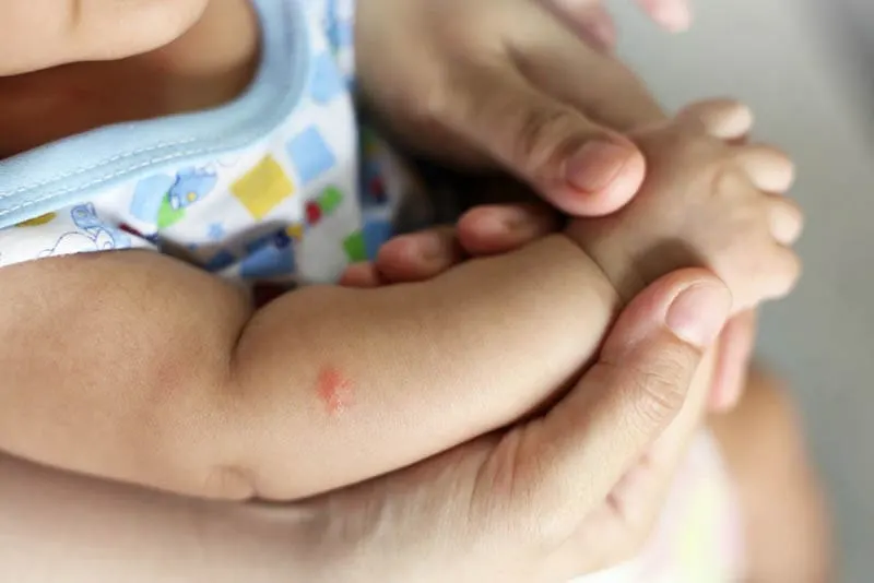 kleines Baby, das unter Mückenstich am Arm leidet