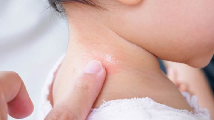 Erste Hilfe Gegen Mückenstiche Beim Baby