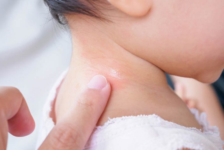 Mutter setzt Creme auf Mückenstich auf Babyhaut