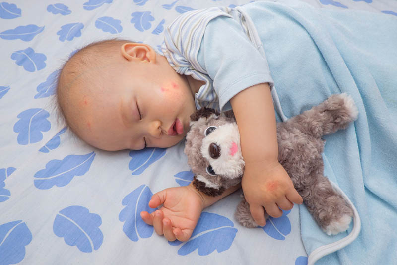 süßes Baby mit Mückenstichen auf der Wange schlafend