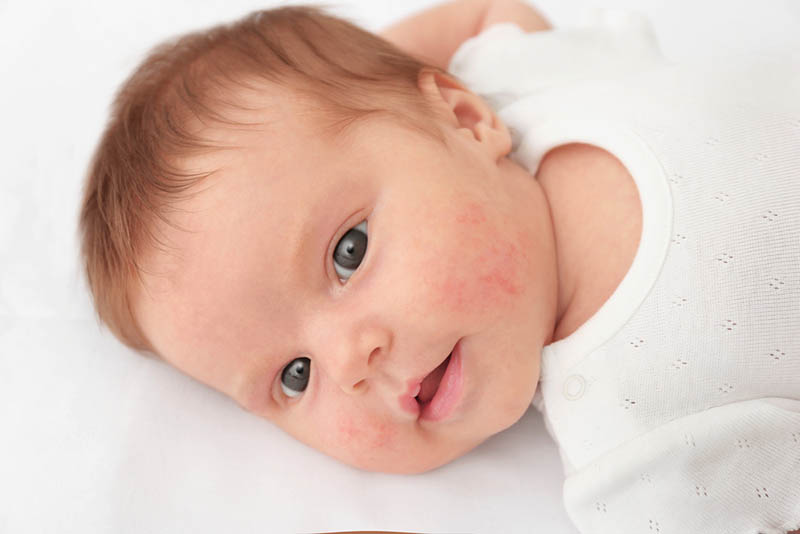 süßes Baby Junge mit einer allergischen Reaktion auf der Wange