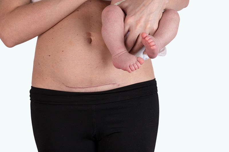 Frau mit Kaiserschnittnarbe hält Baby in den Händen