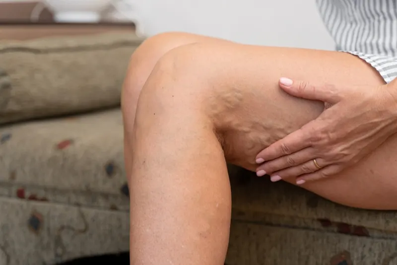 Schwangere Frauen mit Krampfadern, die ihr Bein halten