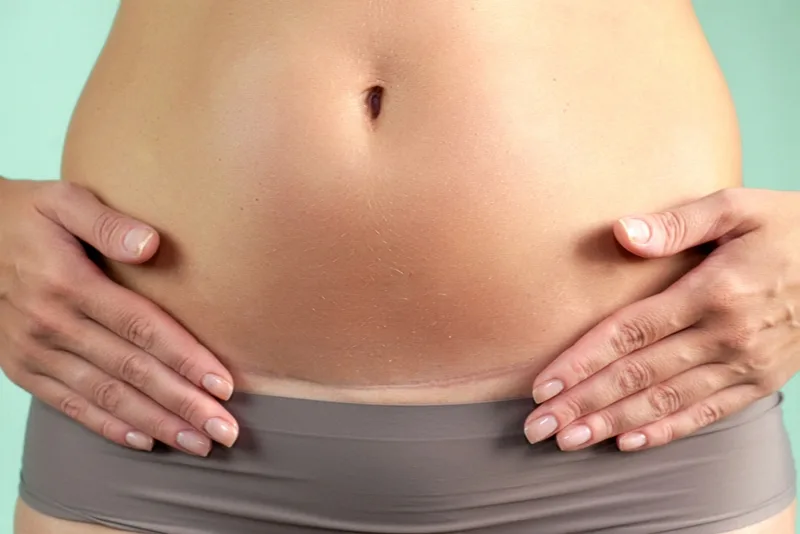 Frau hält Hände auf dem Bauch auf Kaiserschnittnarbe