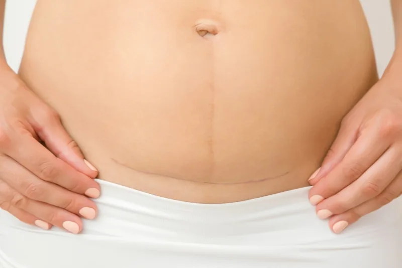 Kaiserschnittnarbe auf dem Bauch der Frau nach der Geburt