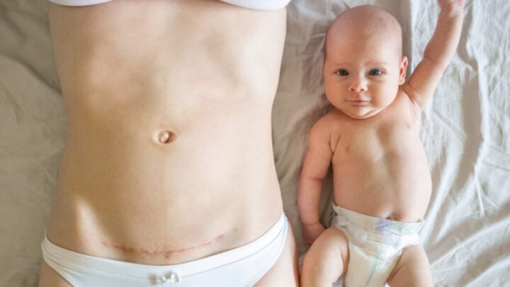 Rückbildung nach Kaiserschnitt – Was beachten?